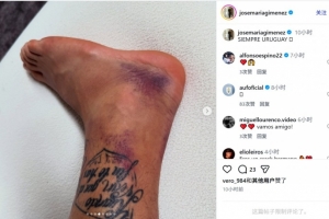 乌拉圭后卫若泽·希门尼斯晒脚踝伤势照片：永远乌拉圭
